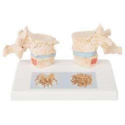 Osteoporose Modell des 11. und 12. Brustwirbels 