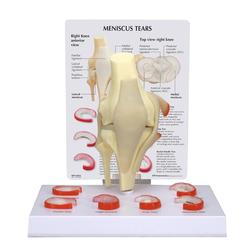 Knie Modell Meniskus - 6 Risse / Bild 1