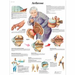 Lehrtafel - Arthrose