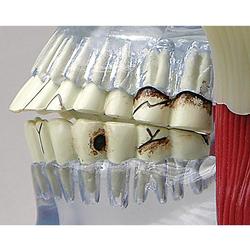 Kiefergelenk Modell mit Muskeln (TMJ) / Bild 2