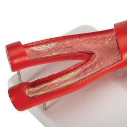 Arteriosklerose Modell mit Querschnitt der Arterie 2-teilig  / Bild 8