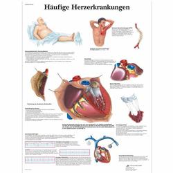 Lehrtafel - Häufige Herzerkrankungen