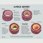 Arterie 4 Scheibenmodell Arterienabschnitte mit Griff / Bild 3