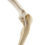 Ellbogen  links, ORTHObones Standard / Bild 3